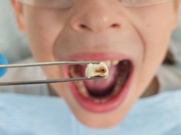 Best Broken or Chipped Tooth Repair in Vance, AL